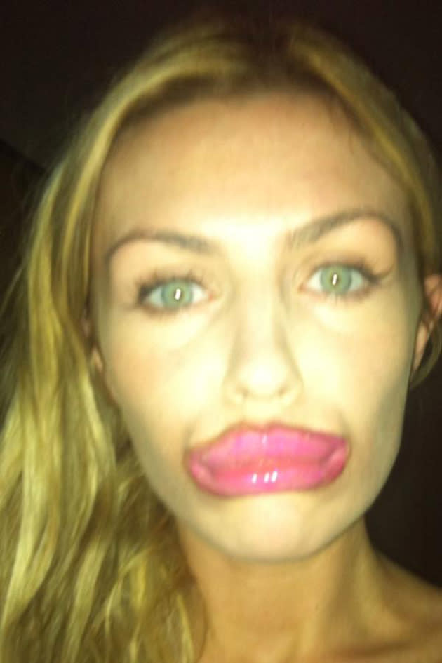 Abbey Clancy took to Twitter this week to dismiss rumours that she's had collagen injections in her lips to plump them up. She posted this pic of her lips comically made up along with the caption: "I swear I haven't had my lips done!!!! #foralltheintelligentpeopleoutthere!" Well, that told us then.