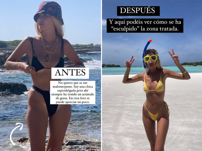 Teresa Andrés Gonzalvo muestra el resultado de su liposucción