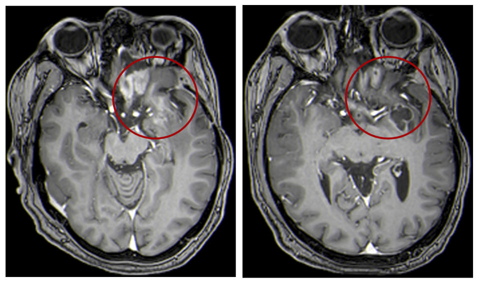 This combination of MRI images provided by the University of Alabama in April 2021 shows scans of a child with a brain tumor, before and after a treatment that involves using viruses to spur an immune system response to the cancerous cells. Lighter-colored areas inside the red circles indicate the tumor size. (UAB via AP)