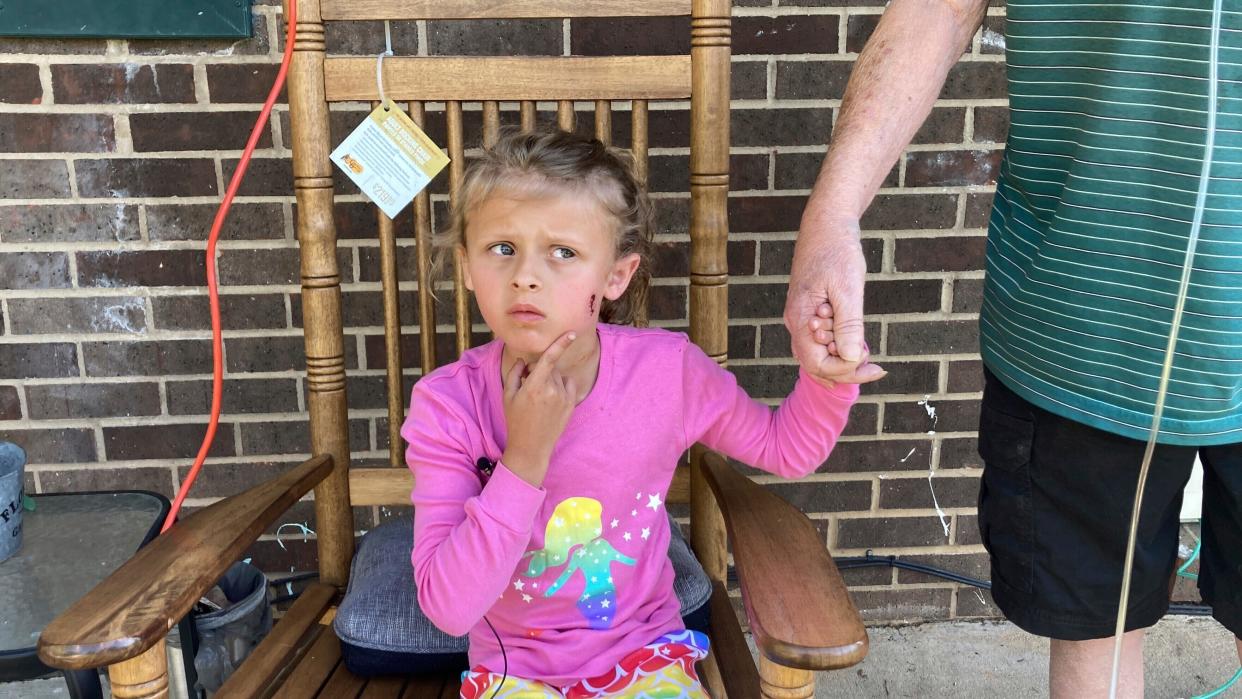 Kinsley White, 6, shows reporters a wound left on her face, Thursday, April 20, 2023 in Gastonia.