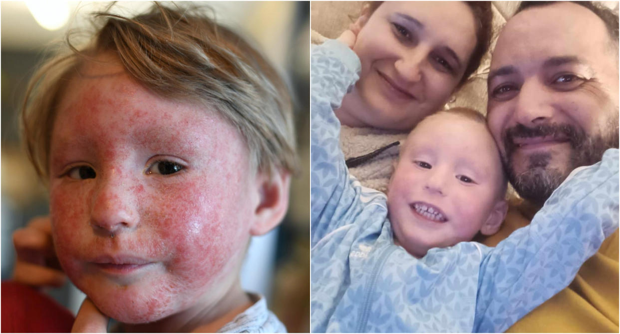 Gabriel Dias (left and with his parents, right) has received life-changing treatment for his severe eczema. 