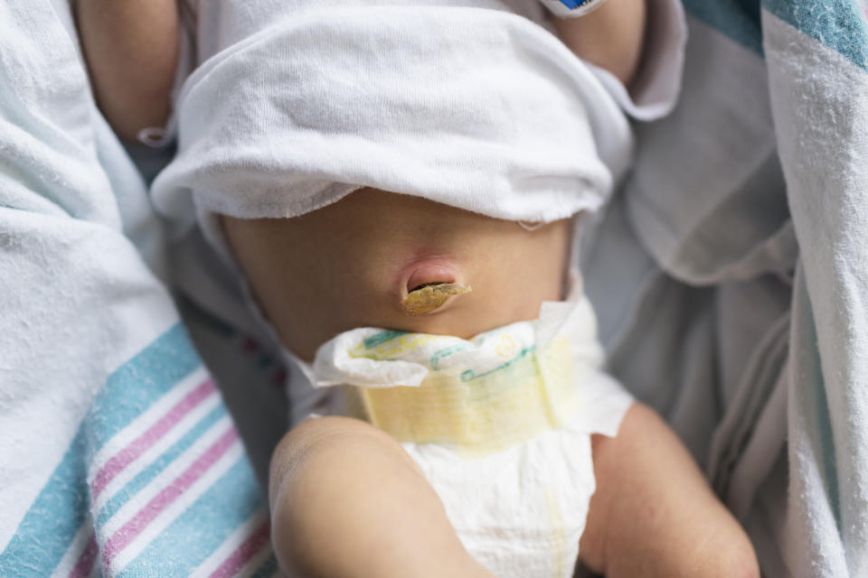 Parents are opting to freeze the blood from their baby's umbilical cord [Photo: Getty]