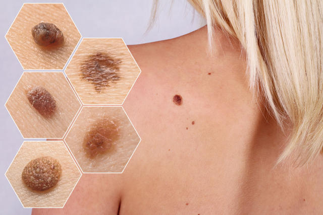 cancerous moles early signs