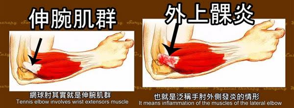 網球肘的真實名稱為外上髁炎，也就是泛稱手肘外側發炎的情形。（圖片／擷取自Sunguts youtube影片）