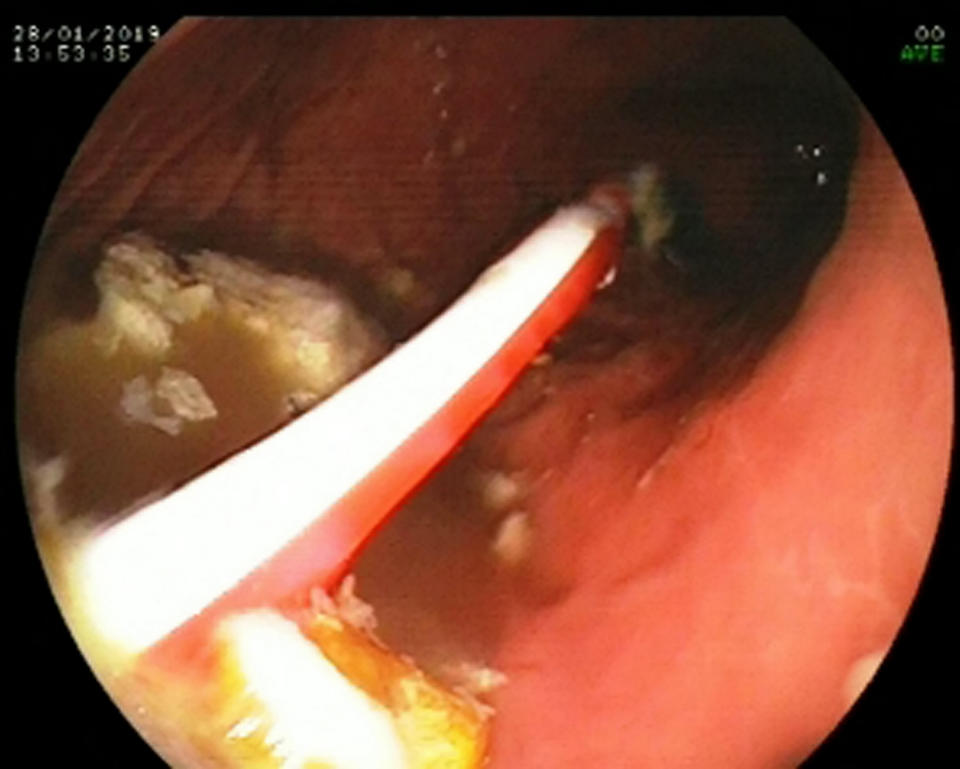 <em>Surgeons found the brush wedged in the woman’s stomach (Picture: SWNS)</em>