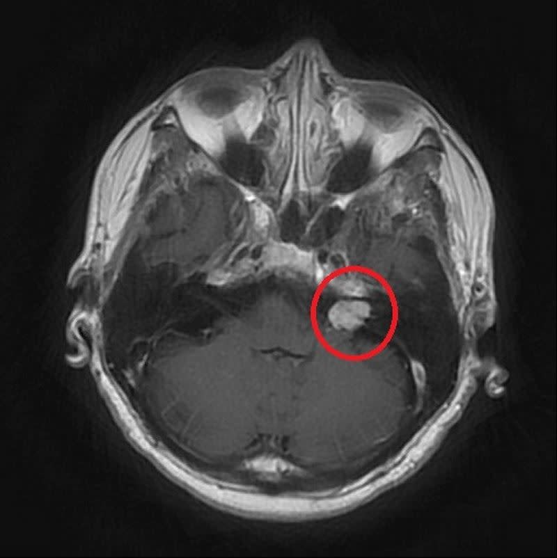 術前核磁共振顯示紅圈處有一小於2公分大的腫瘤。（圖／台北慈濟醫院提供）