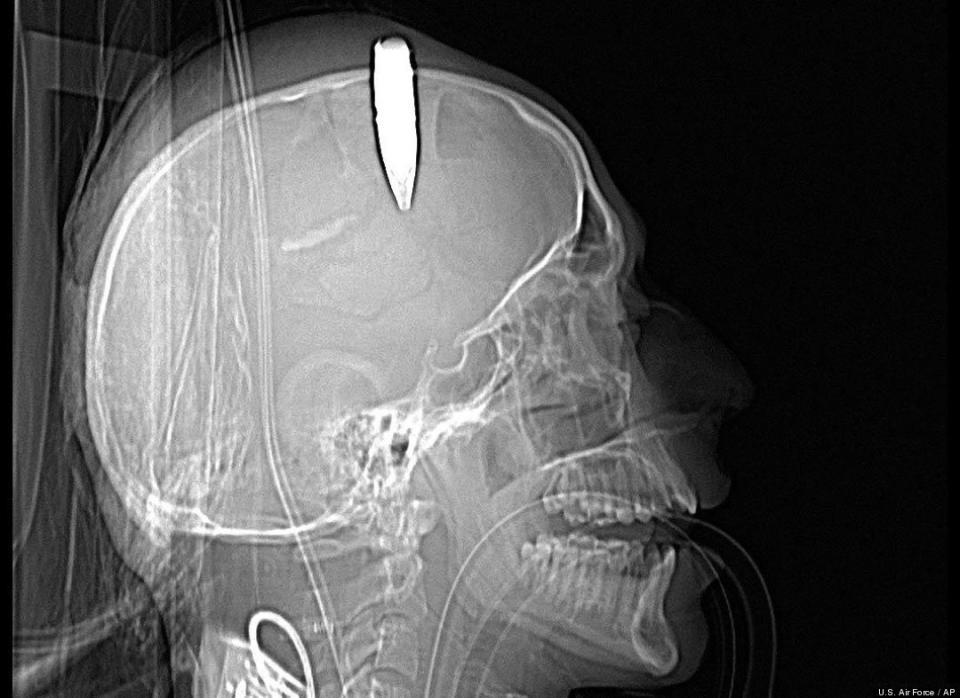 A CT scan shows a 14.5 millimeter live round of ammunition lodged in the skull of an Afghan soldier. A U.S. military doctor successfully removed the unexploded round -- more than 2 inches long -- at the Bagram Air Field hospital in Afghanistan last month. 