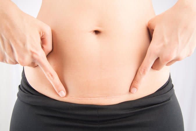 guida per riprendersi dal parto cesareo