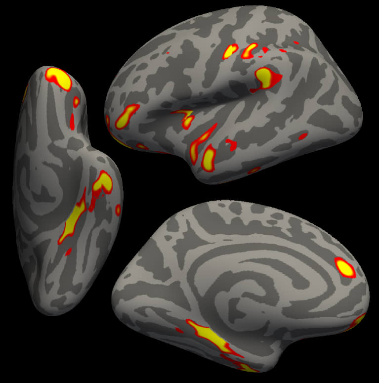 The red-yellow regions are the parts of the brain that shrink the most in the 401 SARS-CoV-2 infected participants (Gwenaëlle Douaud, in collaboration with Anderson Winkler and Saad Jbabdi, University of Oxford and NIH.)