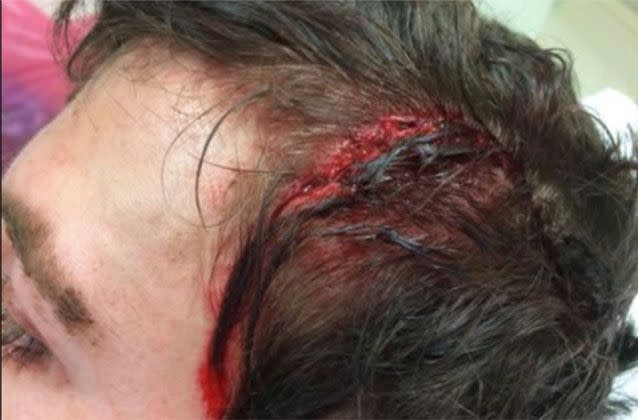 The 20-year-old received seven staples to the head wound. Source: Danny Worth / Facebook