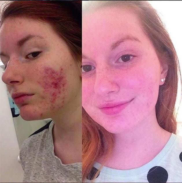 Amanda Sherett's skin before she started using Frank scrub (left) and after three months (right). Photo: Instagram