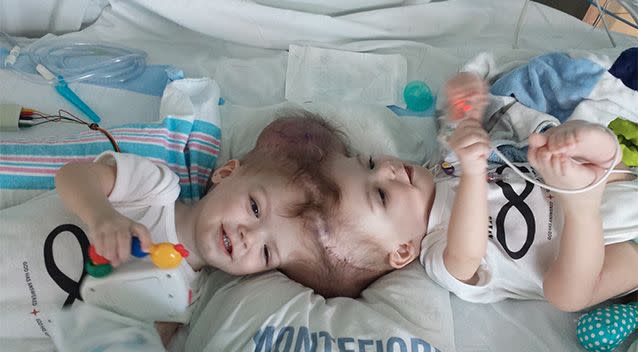 The twins before the operation. Photo: Facebook