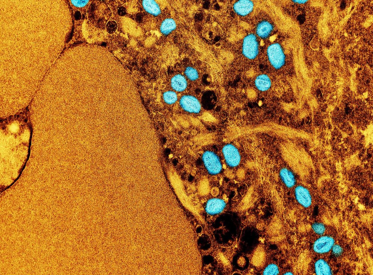 Monkeypox is transmitted mainly through direct contact with skin lesions, but the current outbreak is following patterns similar to STIs. (NIAID, cropped from original), <a href="http://creativecommons.org/licenses/by/4.0/" rel="nofollow noopener" target="_blank" data-ylk="slk:CC BY;elm:context_link;itc:0;sec:content-canvas" class="link ">CC BY</a>