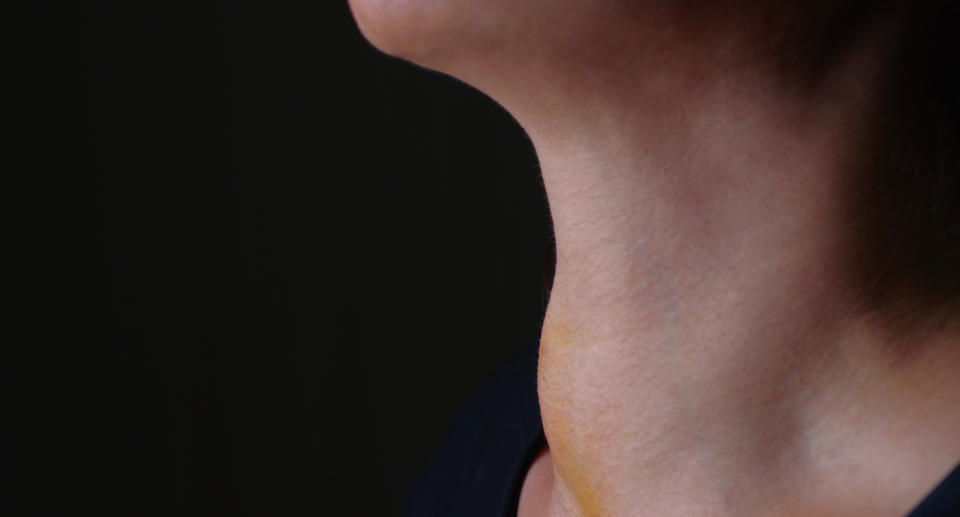 Close up of swelling on woman's neck.