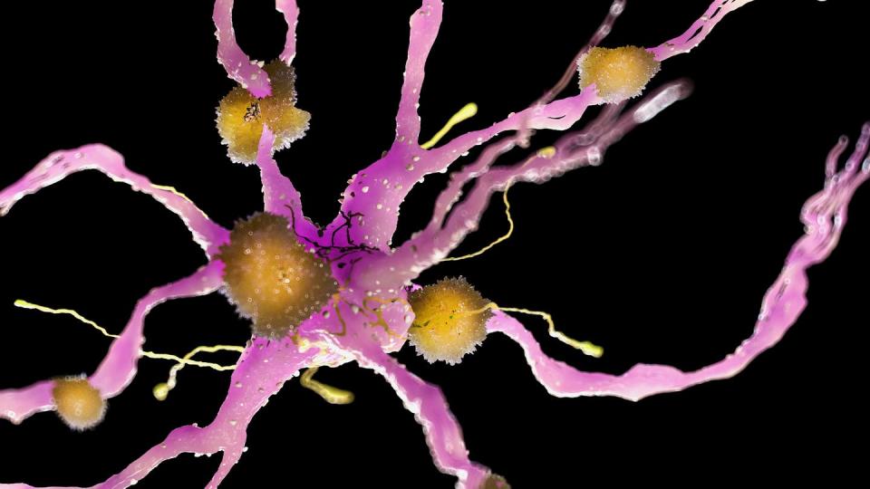 <span class="caption">Illustration of amyloid plaques on a nerverticale cell, which are found in the brain.</span> <span class="attribution"><a class="link " href="https://www.gettyimages.com/detail/illustration/illustration-of-amyloid-plaques-on-a-royalty-free-illustration/1124681594?adppopup=true" rel="nofollow noopener" target="_blank" data-ylk="slk:Getty Images / Sciepro / Science Photo Library;elm:context_link;itc:0;sec:content-canvas">Getty Images / Sciepro / Science Photo Library</a></span>