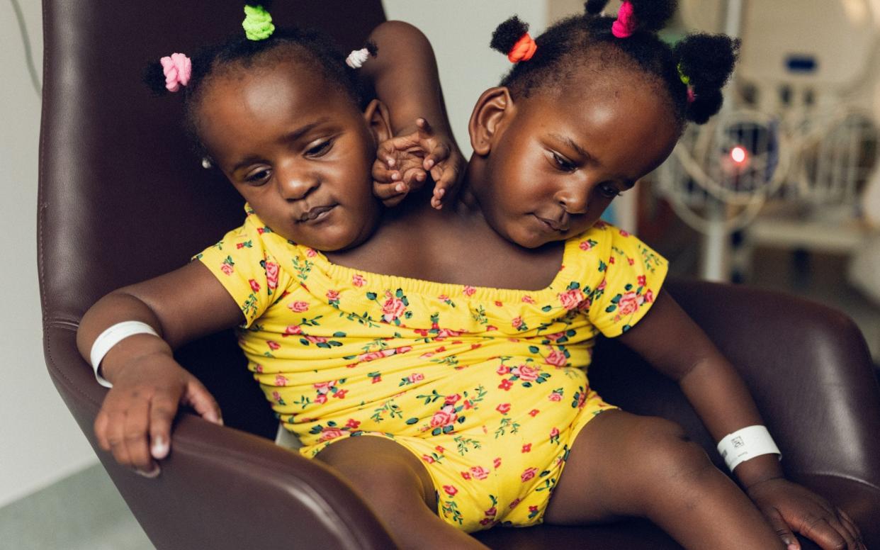 Conjoined twins Mariam and Ndye - WARNING: Use of this copyright image is subject to the terms of use of BBC Pictures' Digital Picture