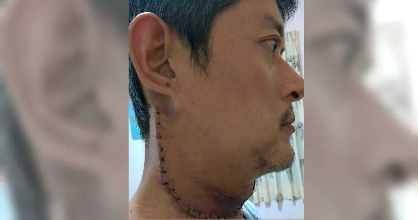 罹患口腔癌的夏先生歷經7次手術，沿著下巴到頸部的疤痕相當明顯。（圖／夏先生提供）
