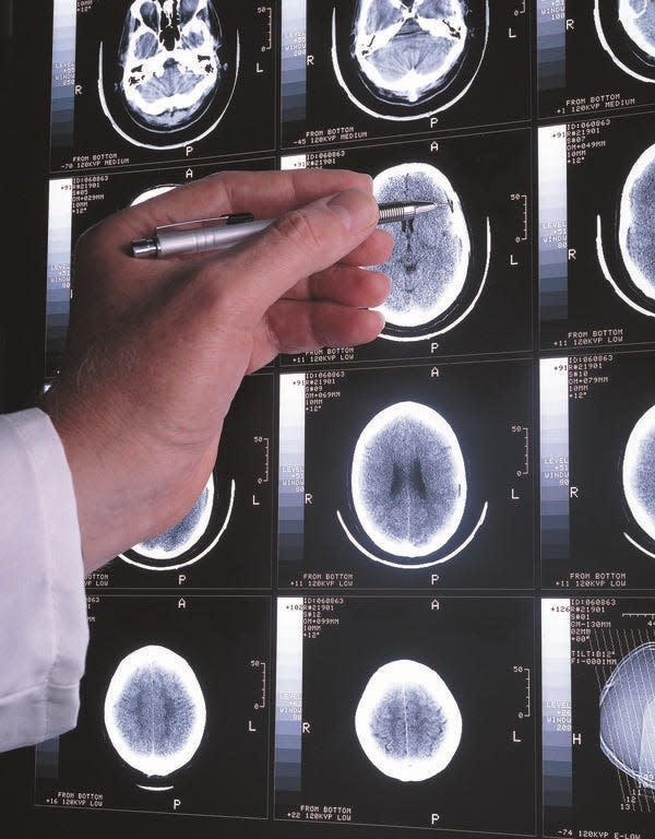 A doctor examines a brain scan.