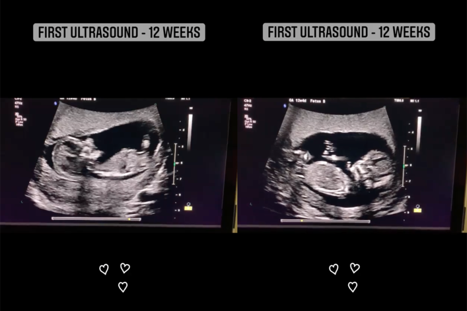 Melissa's ultrasound.