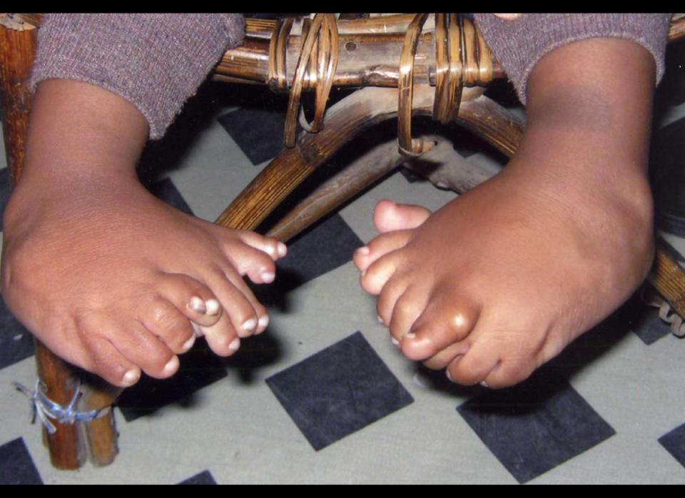 Akshat Saxena had 34 fingers and toes at birth in India in 2010. That set a Guinness World Record for most digits, although doctors later amputated many of them in 2011. 