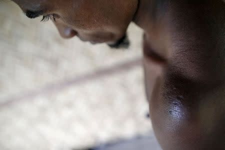 A victim of forced labor displays the scars on his shoulder during a Reuters interview in a village at Buthidaung township in northern Rakhine state June 10, 2015. REUTERS/Soe Zeya Tun