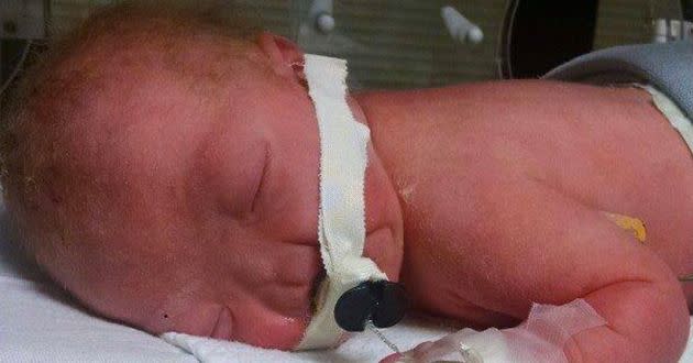 Eli Thompson was born without a nose on March 4. Photo: Facebook
