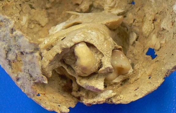 A close-up view of the two teeth still attached to the tumor.