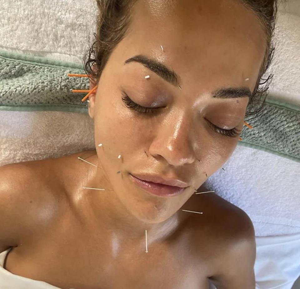 Rita Ora uses acupuncture for face-sculpting (Rita Ora)