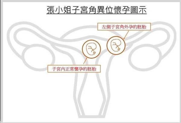 張小姐子宮角異位懷孕圖示。（圖片提供／台北長庚醫院）