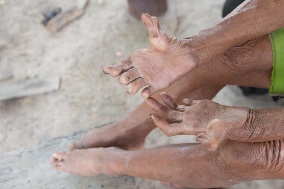 The hands and feet of an old man suffering from leprosy, showing some fingers and toes reduced to stumps.