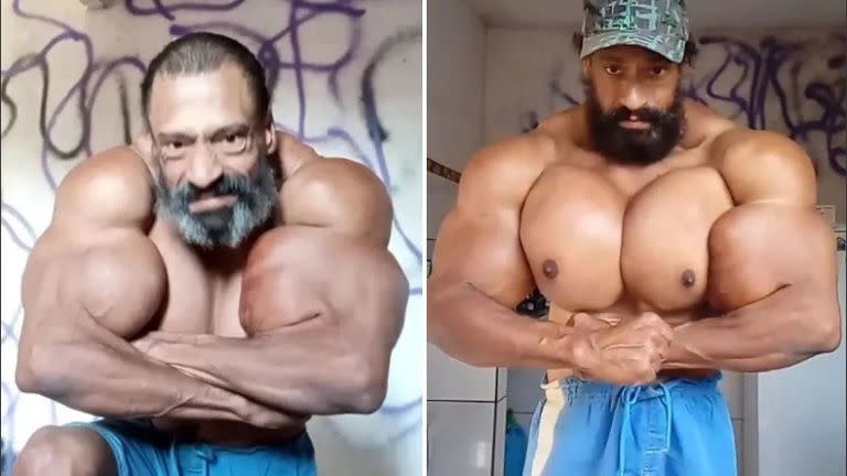 Murió el “Hulk brasileño”, un famoso fisicoculturista que se había inyectado aceite en sus músculos.