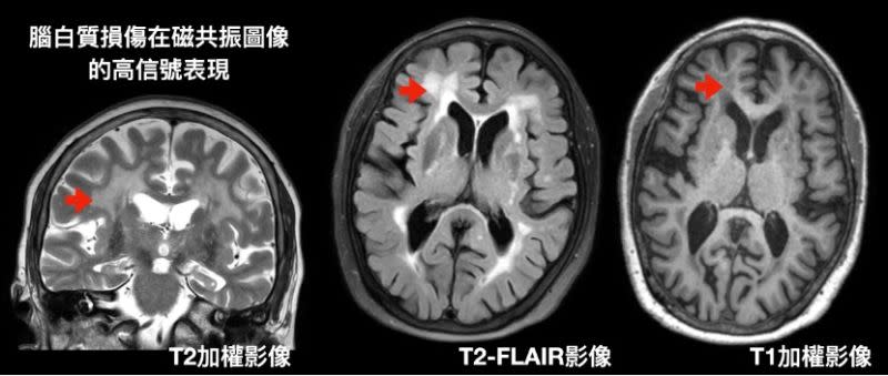 ▲陽明交大團隊建立一套腦白質分析技術來估算腦血管年齡的方法。圖為大腦白質照片示意圖。（圖／陽明交大提供）