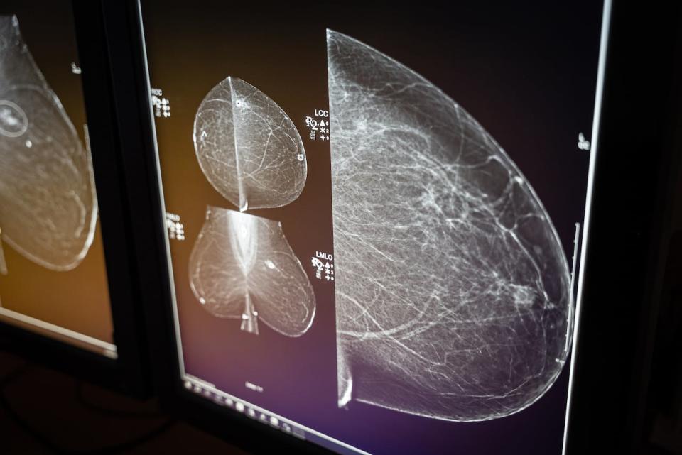 A mammogram is shown here, which is an X-ray picture of the breast that is used to screen for cancer. 