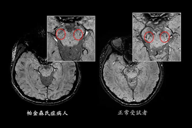 正常人腦部影像的中腦黑質緻密部，會出現燕子尾巴分岔狀特徵（右），帕金森氏症病患則因分泌多巴胺的細胞逐漸減少，燕子尾巴特徵會慢慢消失（左）。（圖／北醫提供）
