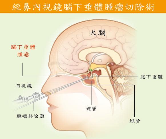 經鼻內視鏡腦下垂體腫瘤切除術