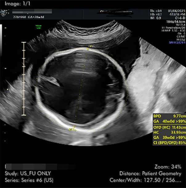 PHOTO: A 28-week ultrasound of the baby's head shows normal brain structures that should have formed and then separated in the midline are not there. (Courtesy Kylie Overdorf)