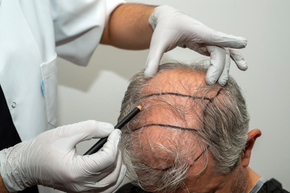 a doctor outlining the scalp of a man for a hair transplant