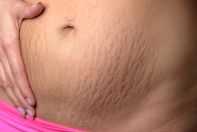 How to prevent stretch marks