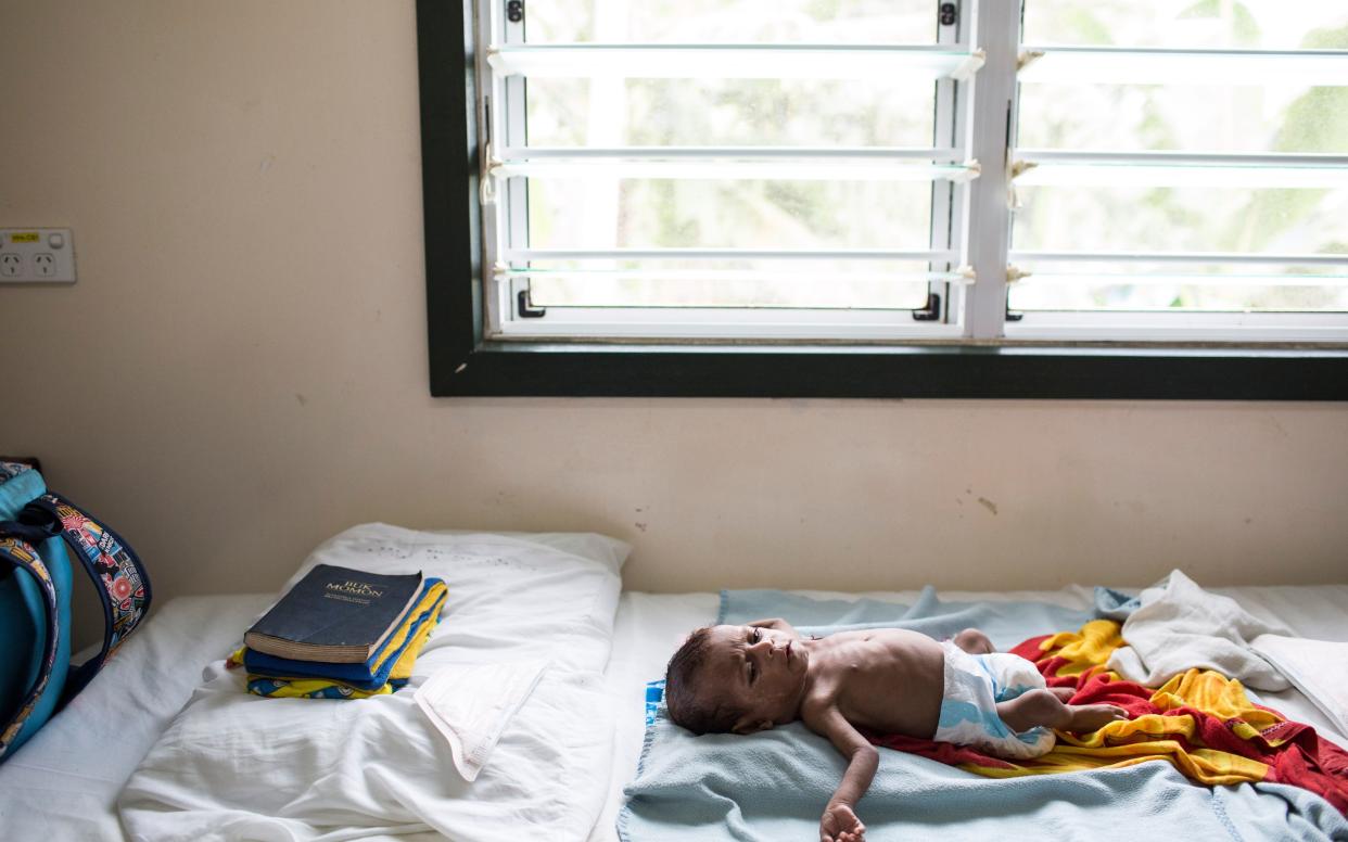 A baby with multi-drug resistant tuberculosis in Papua New Guinea, a country with a high incidence of the disease - TOM MAGUIRE/Results UK