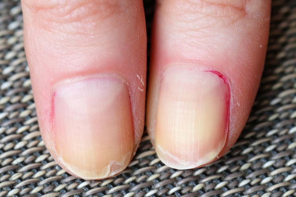 Dry skin with brittle splitting and peeling nails from biting