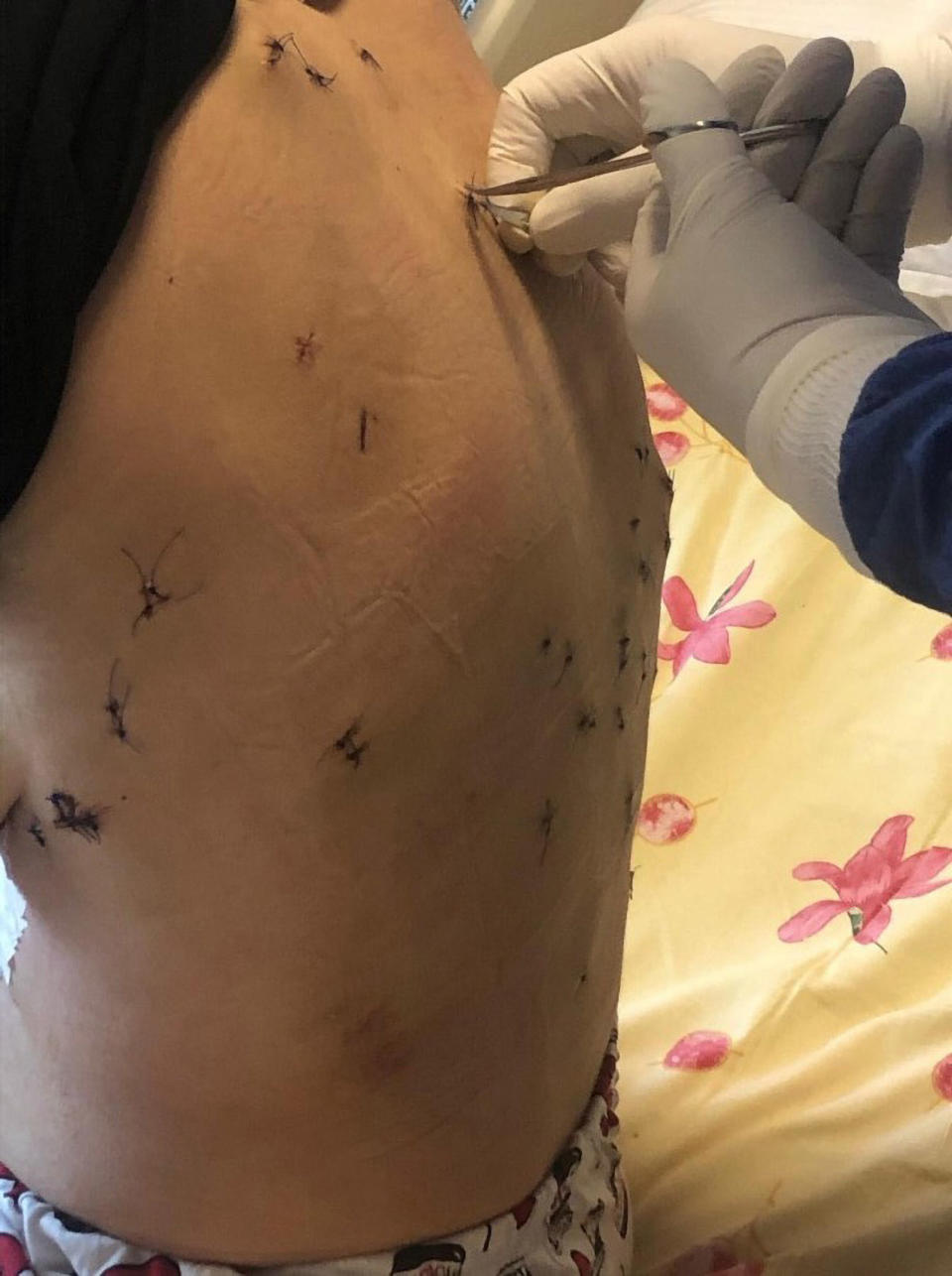 Aycan's stab wounds on her back. Source: Newsflash/Australscope