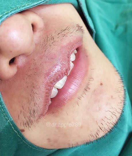 In circa 80% der Fällen sind es junge Frauen, die sich eine Lippenverkleinerung wünschen, doch auch immer mehr junge Männer lassen sich operieren. Foto: Instagram ( mor.ple_surgery)