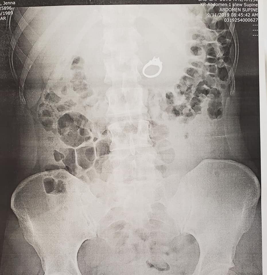 An x-ray of a woman's abdomen taken after she swallowed an engagement ring while asleep.