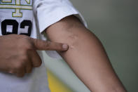 A drug suspect, who uses the alias Lazarus for security, shows a scar from a gunshot wound during an interview with the Associated Press at an undisclosed location on the outskirts of Manila, Philippines on June 27, 2022. Lazarus, who was gunned down and left for dead by police officers but surprisingly survived the violence in a dark Metro-Manila alley in 2016, said he still fears for his life but would be willing to testify in the ICC to get justice and possible state reparation. (AP Photo/Aaron Favila)