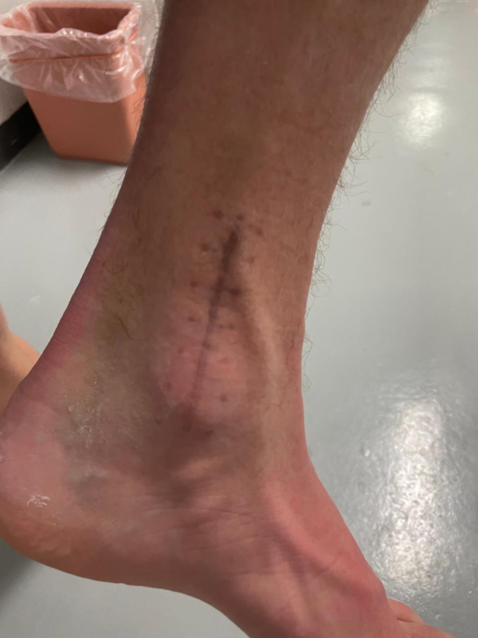The scar on West Central forward Wilson Droge's foot following surgery to repair a broken ankle during the Trojans' football season. Photo taken Jan. 22, 2022.