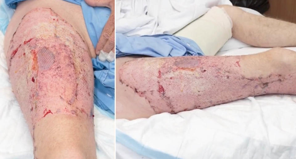 Burns on leg from exploding vape.