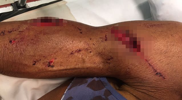 It took 35 stitches to close the deep, gaping wounds. Photo: Supplied