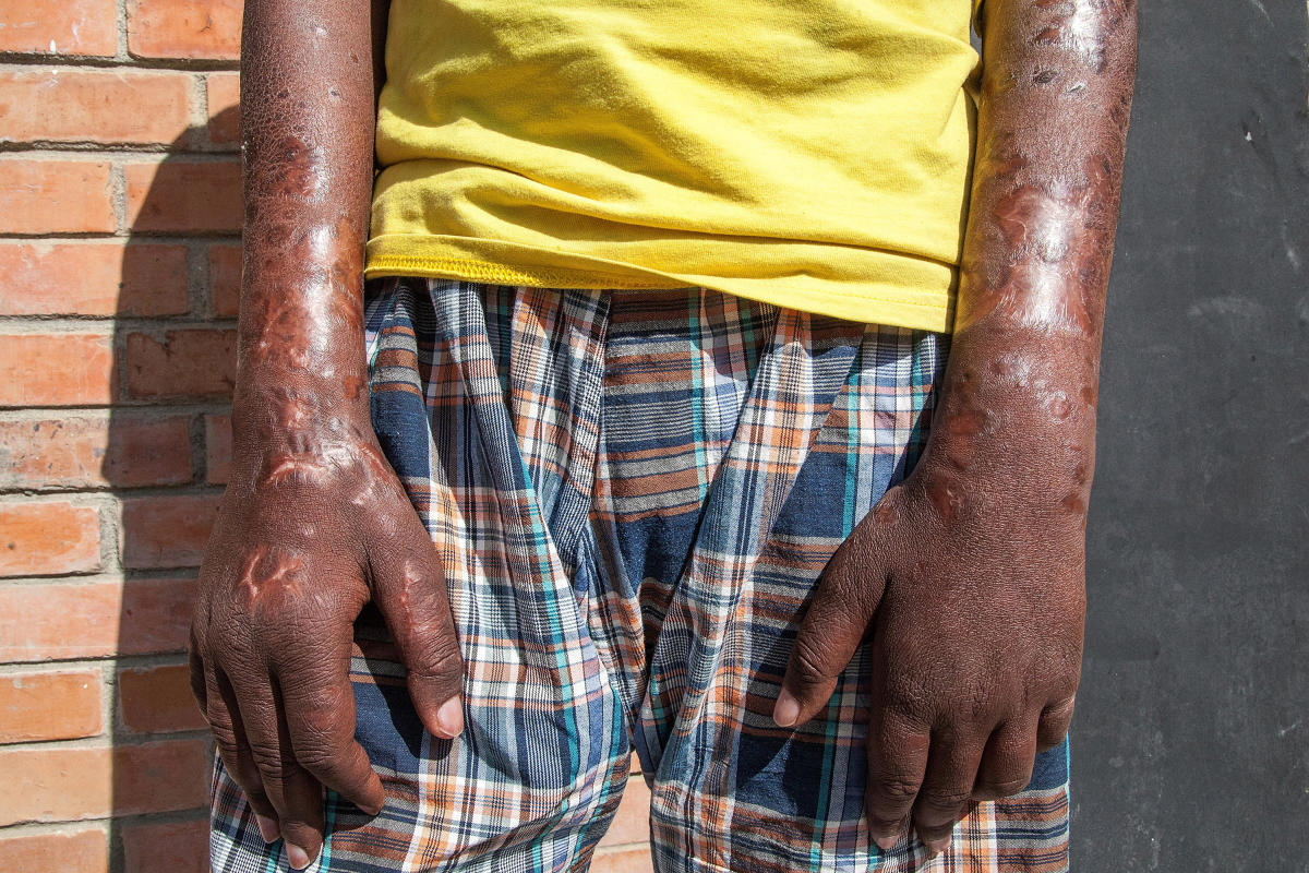 cdc travel leprosy