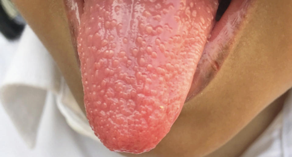 A girl, 5, with a strawberry tongue caused by strep throat.