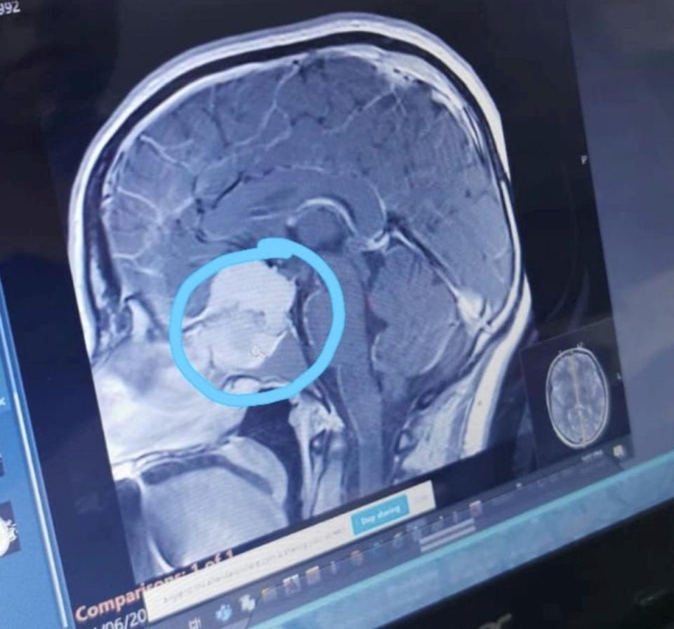 A scan of the tumour (circled) in Katie Dunn's brain, 20 October 2021 (Brain Tumour Research / SWNS)